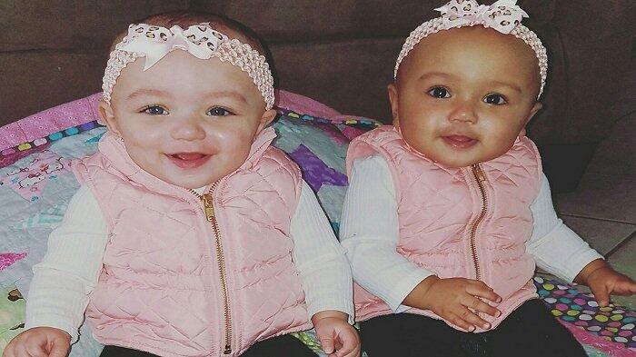 Kisah Unik Kalani dan Jarani, Dua Bayi Kembar yang Memiliki Warna Kulit Berbeda