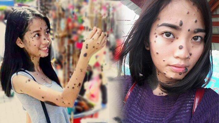 Dulu Sering Dibully Karena Tahi Lalat, Kehidupan Gadis Ini Kini Berubah 180 Derajat