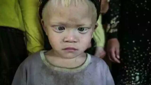 Kisah 'Walanda Sunda' di Kampung Albino Ciburuy