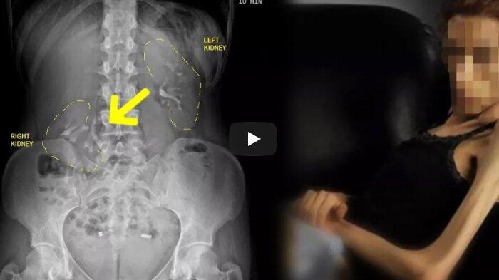 Ngeri, Karena Badannya Terlalu Kurus, Ginjal Wanita Ini Melorot Turun ke Panggul