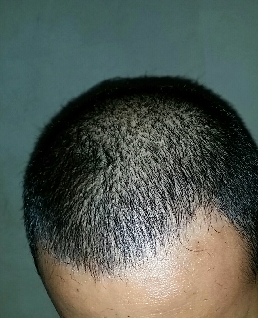 Rambut Gua Rontok Hampir Botak Page 247 KASKUS