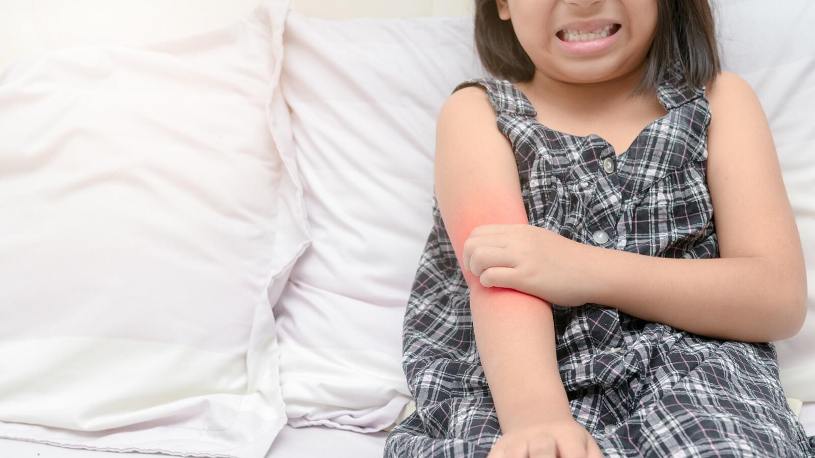 Sakit Tampek Pada Anak: Mengenali Dan Mengobati Dengan Tepat Penyebab dan Cara Mengobati Kaligata pada Anak | KASKUS