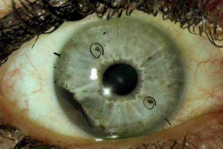 Melanoma Okular Kanker Mata Langka Yang Serang Puluhan Warga As