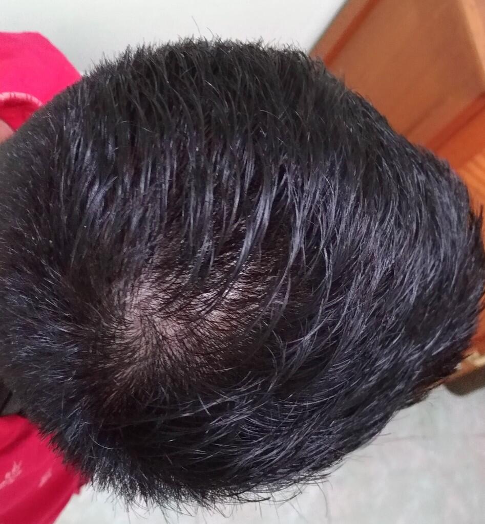 Rambut Gua Rontok Hampir Botak Page 250 KASKUS