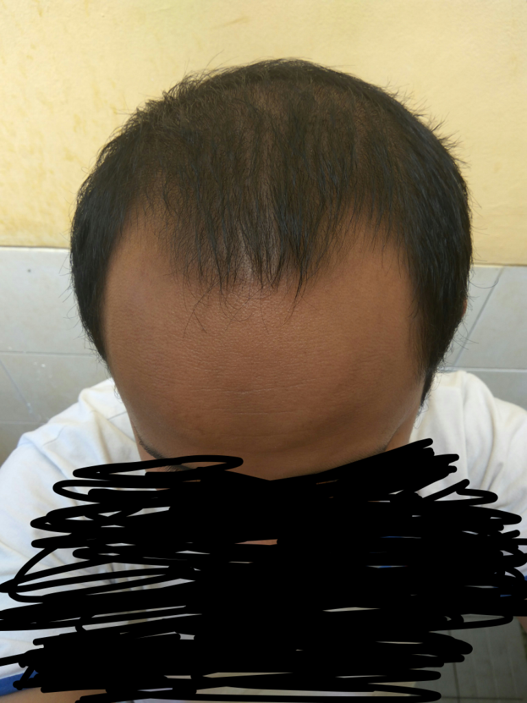 Rambut Gua Rontok Hampir Botak Page 250 KASKUS