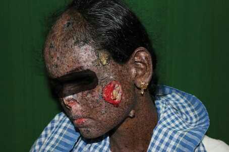 Cacing "ZOMBIE" Mematikan !! Waspadalah Dari Cacing Jenis Ini Gan,Ngeri!!!!!!