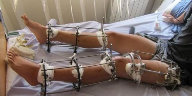 Anda Mungkin Pendek, Tenang, ada Operasi Perpanjang Kaki Kok