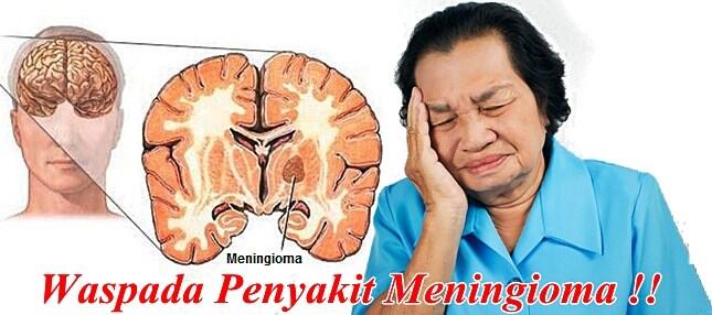 Mengenal Penyakit Meningioma