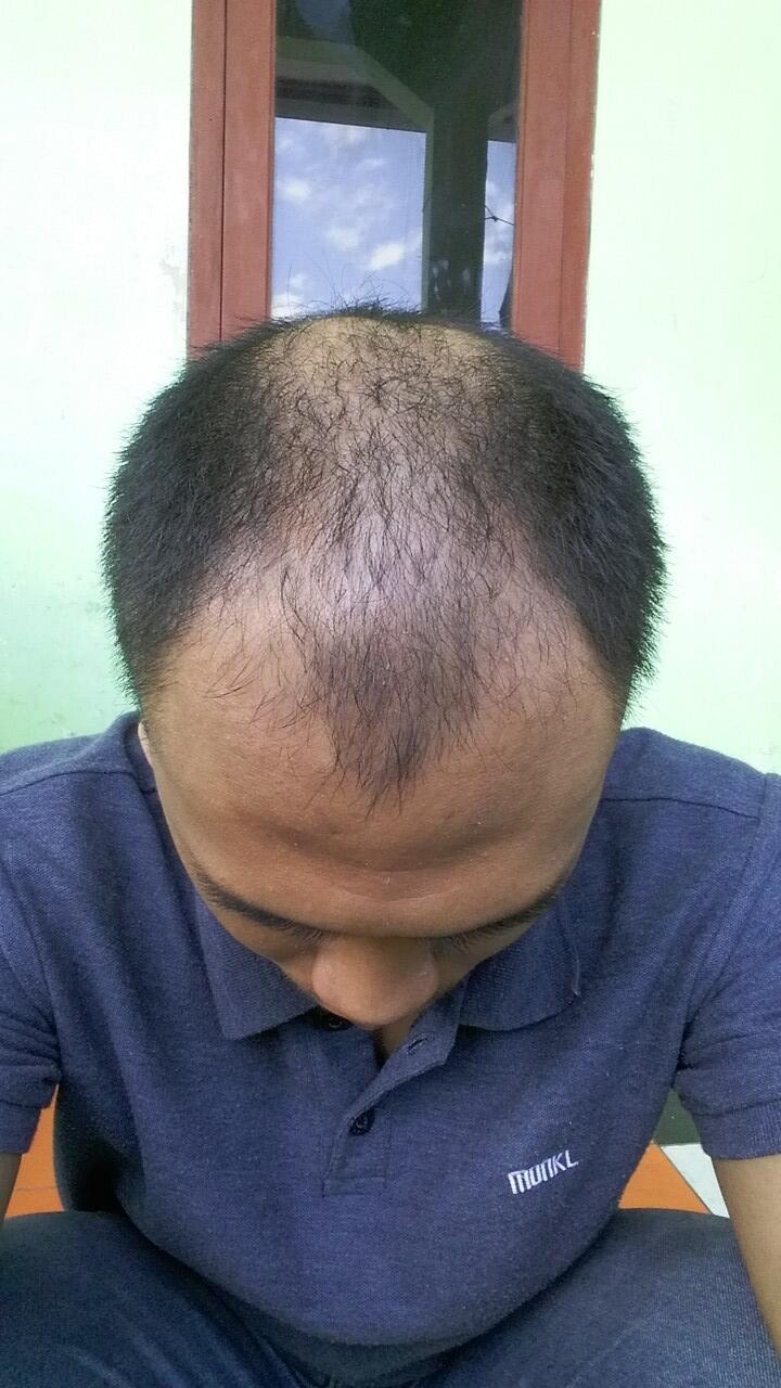 Rambut Gua Rontok, hampir Botak - Page 261 | KASKUS