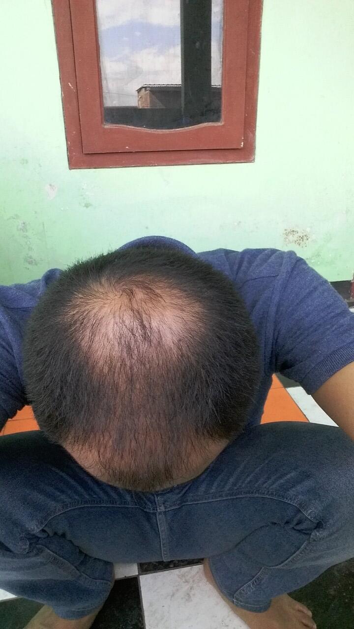 Rambut Gua Rontok Hampir Botak Page 261 KASKUS