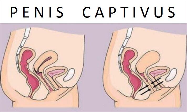 Bagaimana Bisa Penis Terjebak di Vagina Saat Berhubungan Seks?