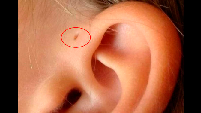 Namaku Preauricular Sinus, Lubang Kecil di Daun Telinga