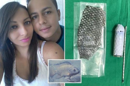 Perempuan Ini Jalani Operasi Pembuatan Miss V dengan Kulit Ikan Nila