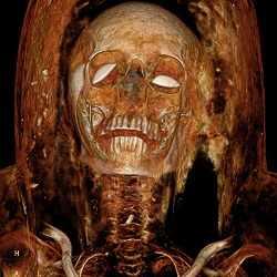 Ilmuwan Memecahkan Misteri Di Balik Mumi Menjerit