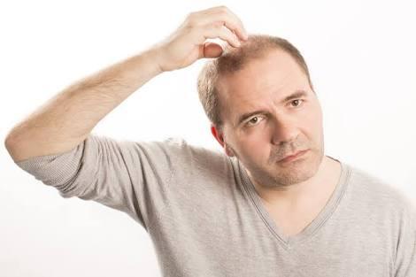 TRIKOTILOMANIA : KEBIASAAN MENCABUT RAMBUT