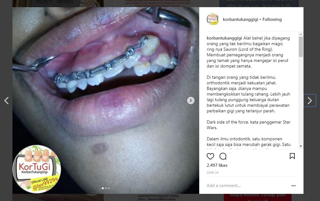 Percayakan Pemasangan Behel dan Veneermu pada Tukang Salon?
