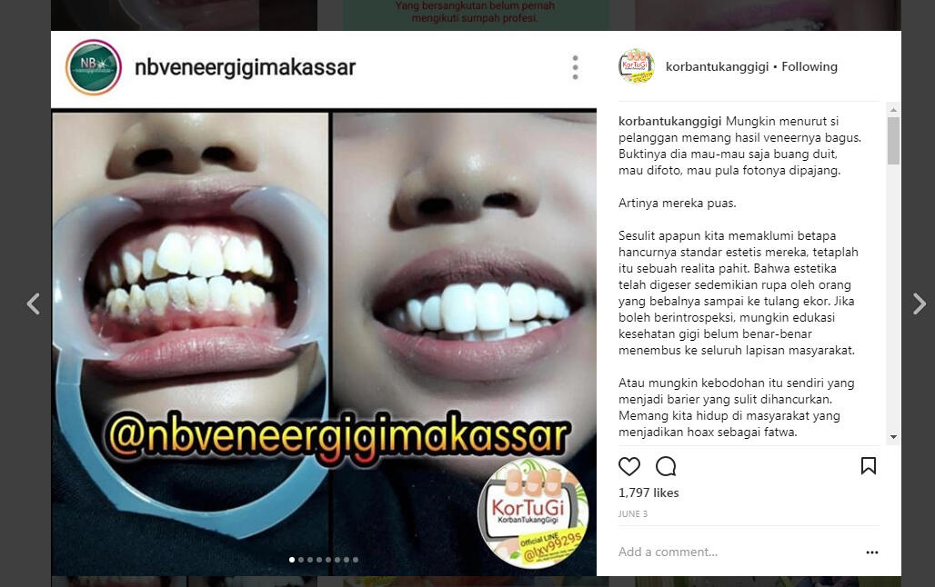 Percayakan Pemasangan Behel dan Veneermu pada Tukang Salon?