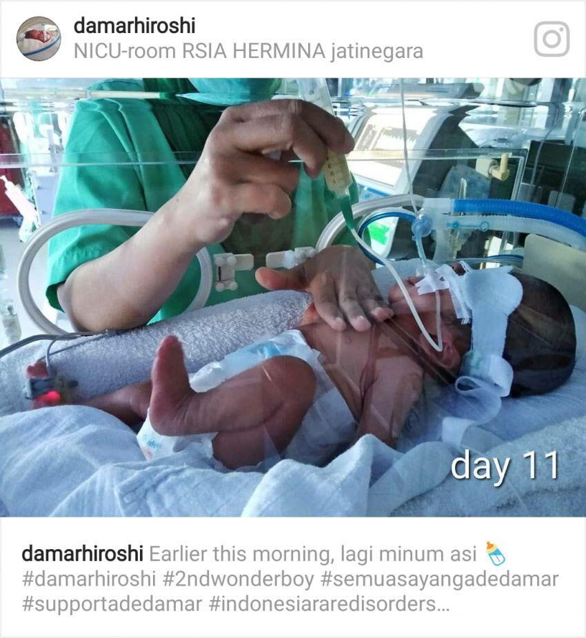- Peduli Kasih - MARI Kita bantu adik Damar melawan penyakit langka Apert Sindrom