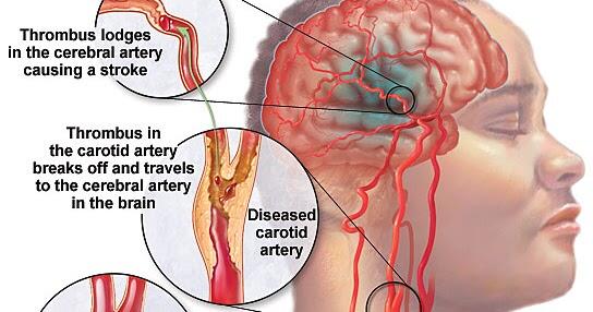 Rajin Olahraga, Tubuh Kekar, dan Baru Berusia 40-an, Kok Bisa Kena Stroke?