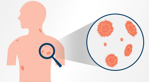 Cara Mengobati Infeksi Tuberkulosis Secara Alami