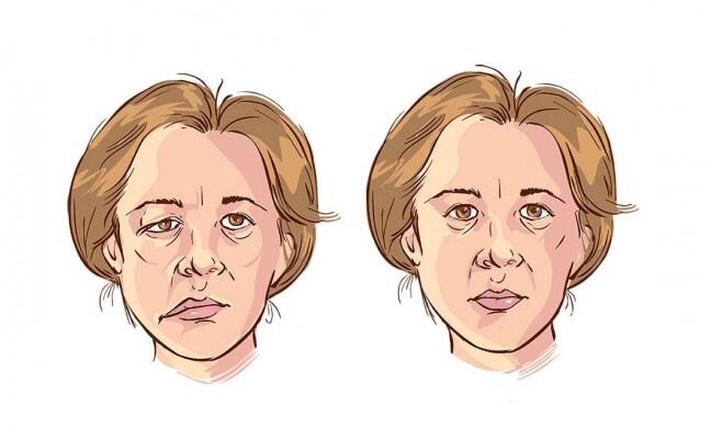 Wajah lumpuh sebelah, pengalaman Bell’s palsy