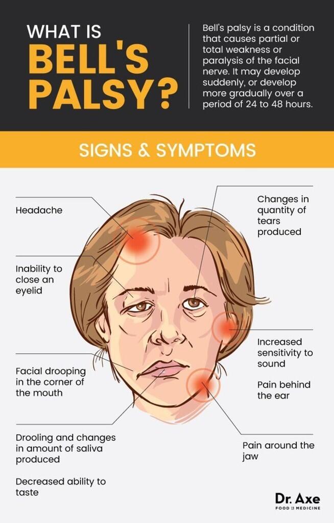 Wajah lumpuh sebelah, pengalaman Bell’s palsy