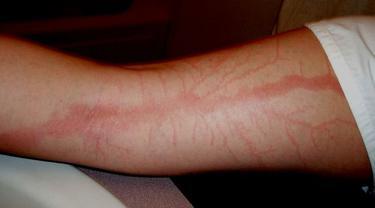 Selamat Dari Sambaran Petir, Orang Ini Membagikan Foto Bekas Luka Petirnya