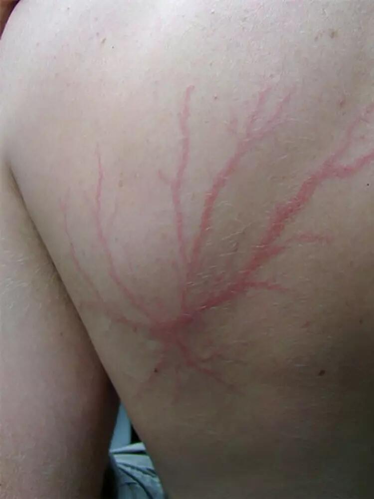 Selamat Dari Sambaran Petir, Orang Ini Membagikan Foto Bekas Luka Petirnya