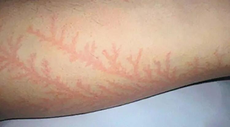 Selamat Dari Sambaran Petir, Orang Ini Membagikan Foto Bekas Luka Petirnya