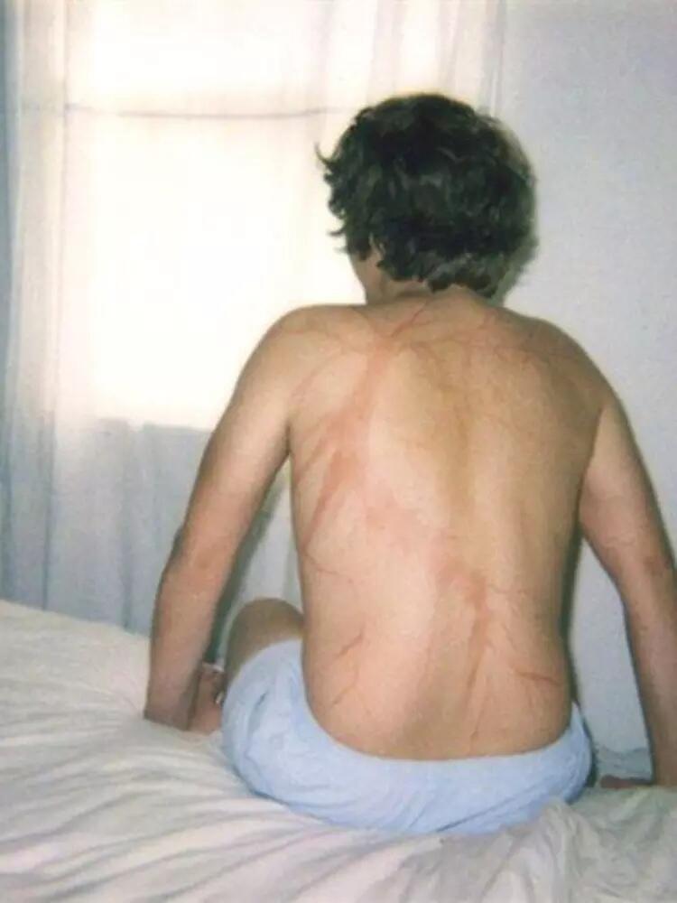 Selamat Dari Sambaran Petir, Orang Ini Membagikan Foto Bekas Luka Petirnya