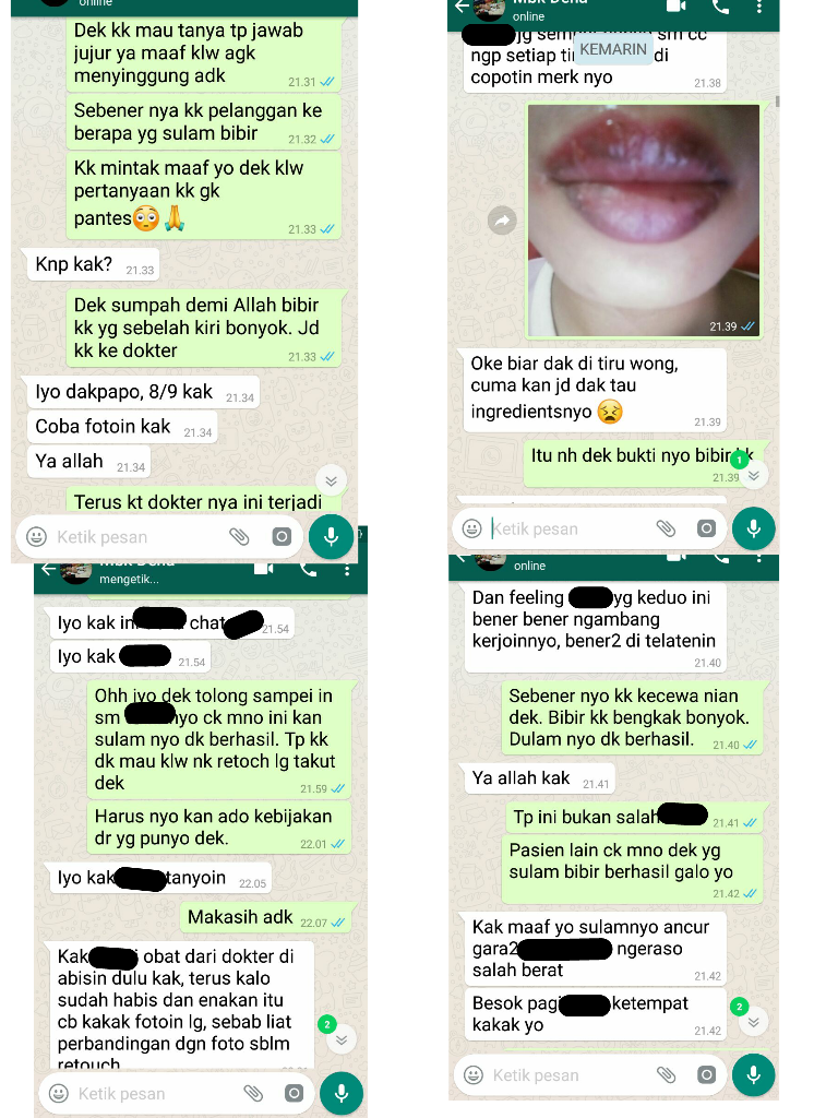 Sulam Bibir Gagal, Bibir Bengkak &amp; Bernanah! (Pengalaman Teman)