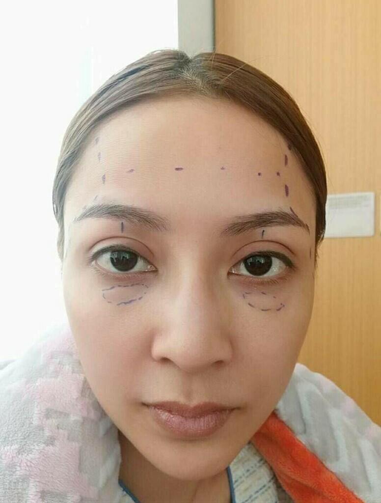 Operasi plastik pada wajah dengan hasil yang.....