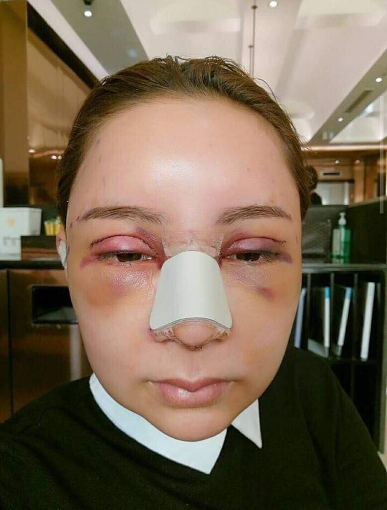 Operasi plastik pada wajah dengan hasil yang.....