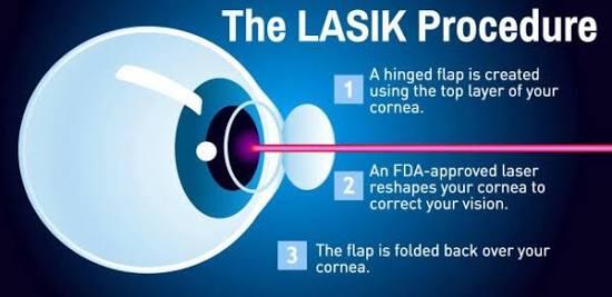 Bebas kacamata dengan operasi LASIK?