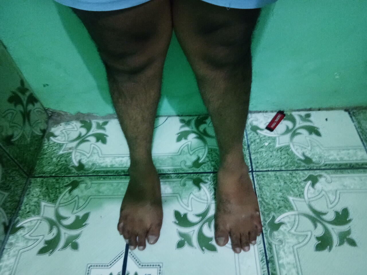 PENYEMBUHAN KAKI X GENU VALGUM DEWASA