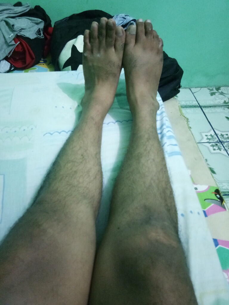 PENYEMBUHAN KAKI X GENU VALGUM DEWASA