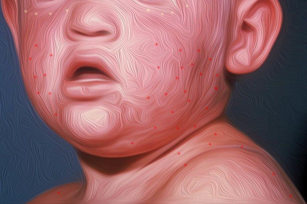 7 Hal Penting Tentang Rubella, Wabah Campak yang Kini Bangkit Kembali