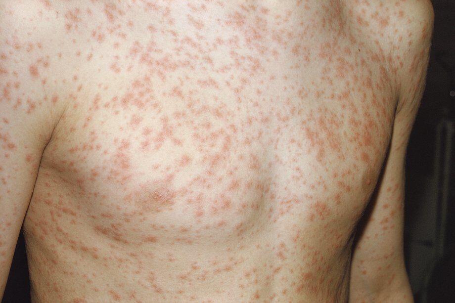 7 Hal Penting Tentang Rubella, Wabah Campak yang Kini Bangkit Kembali