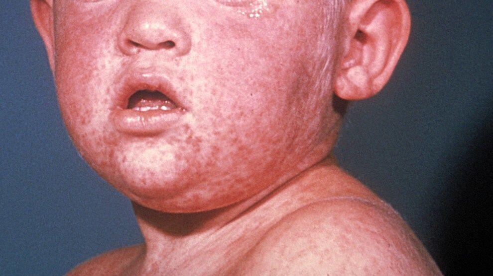 7 Hal Penting Tentang Rubella, Wabah Campak yang Kini Bangkit Kembali