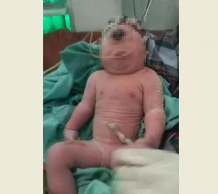 Bayi Bermata Satu Lahir di Madina !!!!