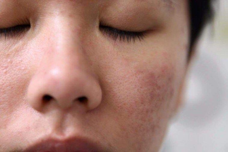 8 Perawatan Kecantikan dengan Kapsul Vitamin E, Bisa dari Rumah!