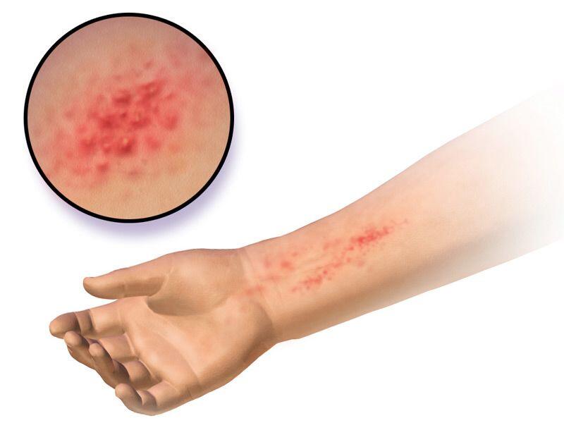 Kenali Witch Hazel, Tanaman "Ajaib" yang Punya 7 Manfaat Hebat ini!