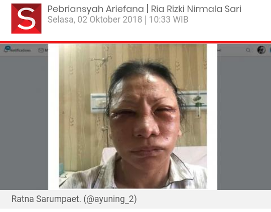 Ratna Sarumpaet Babak Belur Dipukuli, Wajahnya Bengkak