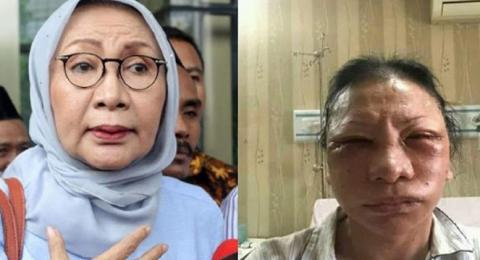 Kejanggalan dalam Foto Ratna Sarumpaet Bonyok Digebuki