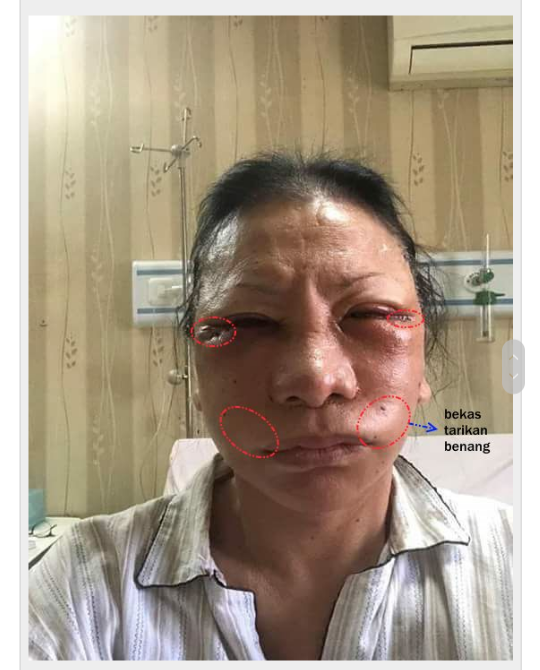 Prabowo: Ratna Sarumpaet dipukuli dan diancam untuk tidak bersuara lagi