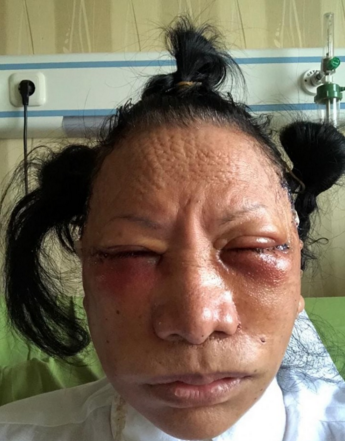 Polisi ungkap fakta lain: Ratna Sarumpaet operasi plastik, bukan dianiaya
