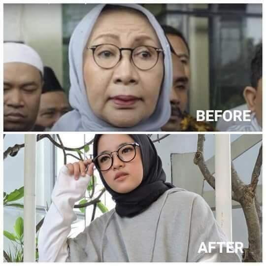 Brekeng news :Ratna Sarumpaet Akui ke Dokter Bedah Plastik, Bukan Dianiaya