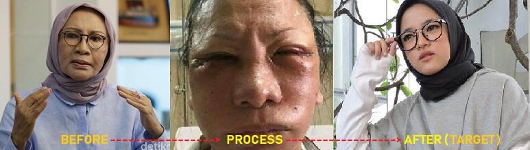 Ratna Sarumpaet: Muka Saya Lebam Berlebihan, Terpaksa Bohong Dipukuli ...