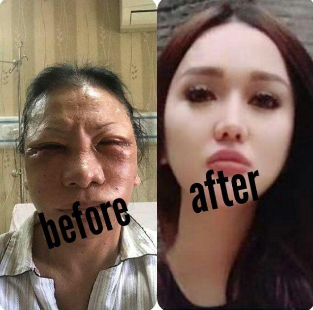 Serba-serbi prosedur operasi plastik