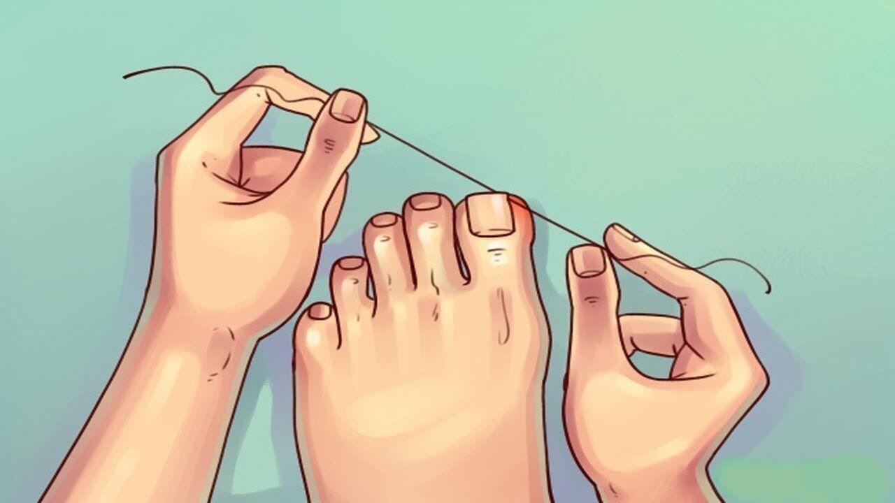 Akali Kuku Jari Kaki yang Tumbuh ke Dalam dengan 5 Cara Ampuh Ini